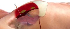 ARS for Needle Decompression